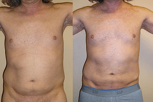 liposuction Before & After Photos