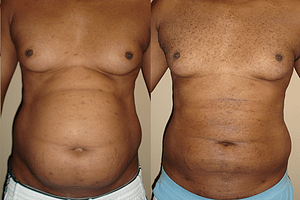 liposuction Before & After Photos