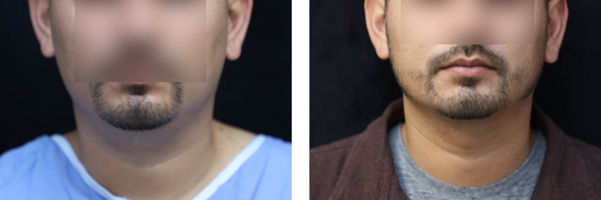 Liposuction for Men Before & After Photos