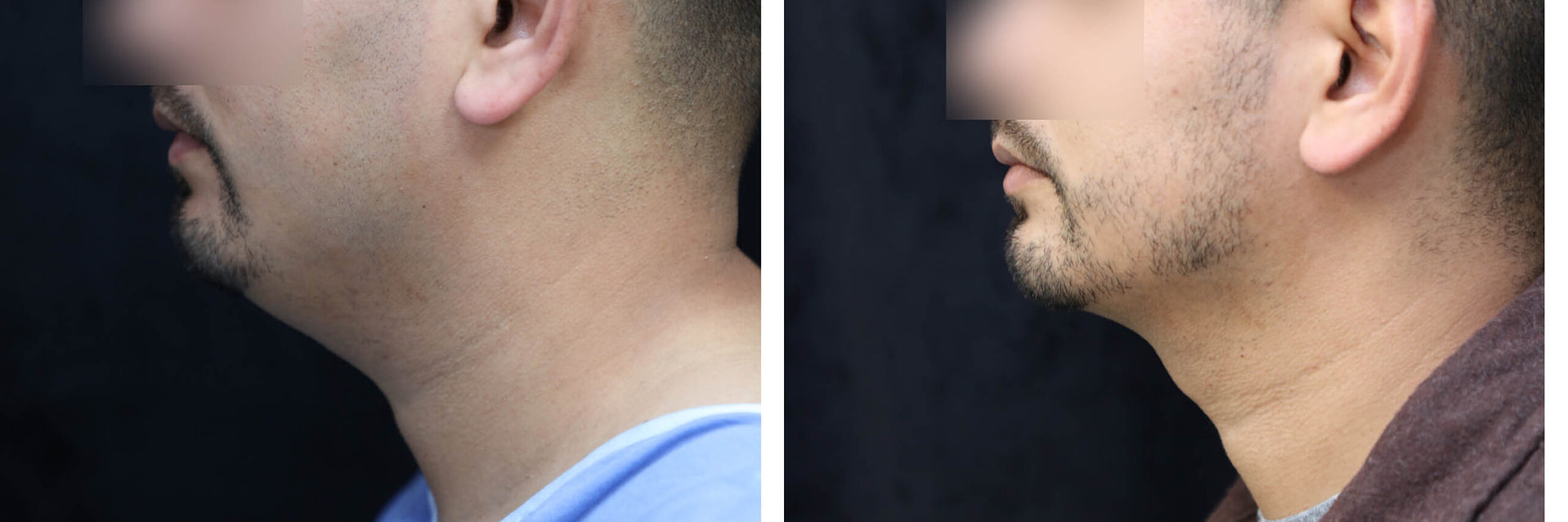 Liposuction for Men Before & After Photos