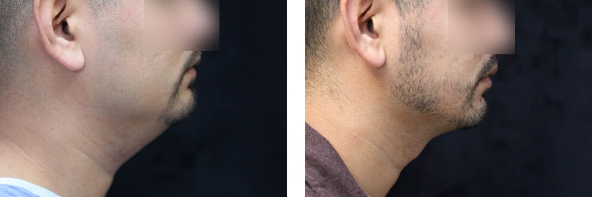 Liposuction for Men Before & After Photos