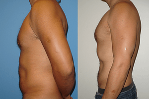Abdomen Liposuction Before & After Photos Left