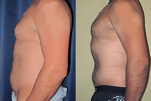 liposuction Before & After Photos