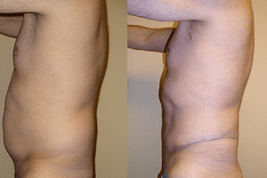 liposuction Before & After Photos