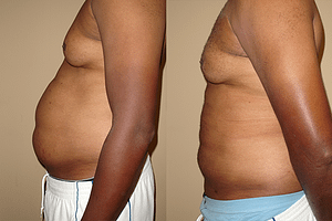 liposuction Before & After Photos