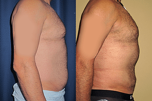 liposuction Before & After Photos