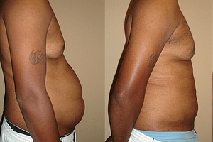 liposuction Before & After Photos