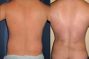 liposuction Before & After Photos