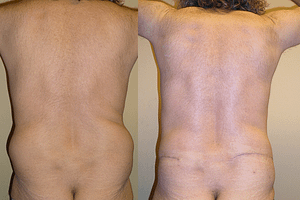 liposuction Before & After Photos