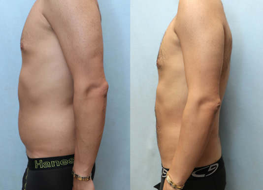 Liposuction for Men Before & After Photos