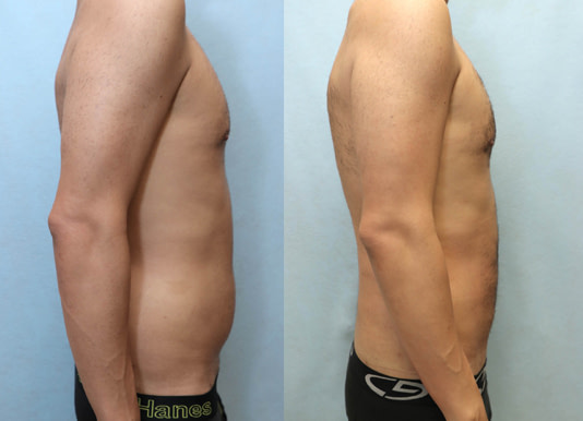 Liposuction for Men Before & After Photos