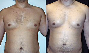 Abdomen, and Chest Liposuction Before & After Photos Front