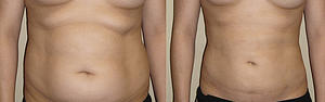 Abdomen, Flanks, and Back liposuction surgery Before & Afte Photos Front