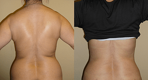 flanks Liposuction Before & Afte Photos Back