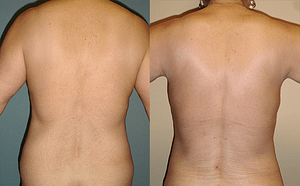 flanks Liposuction Before & Afte Photos Back
