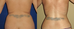 flanks Liposuction Before & Afte Photos Back
