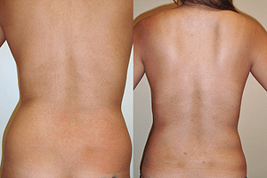 flanks Liposuction Before & Afte Photos Back