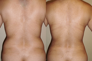 flanks Liposuction Before & Afte Photos Back