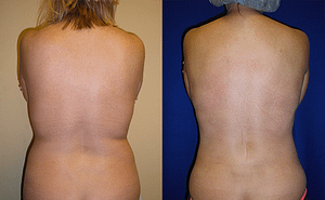 Back and Flanks Liposuction Before & Afte Photos Back