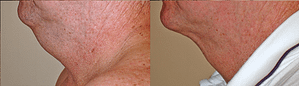 neck liposuction Before & Afte Photos Left