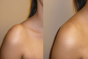 Shoulder LiposuctionBefore & After Photos Right