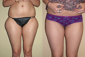 thighs liposuction Before & After Photos Front