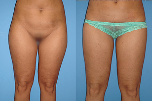 thighs liposuction Before & After Photos Front