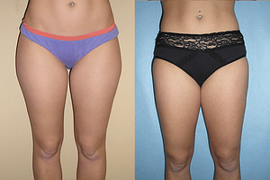 thighs liposuction Before & After Photos Front