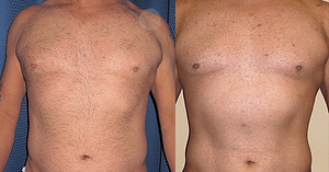 liposuction Before & After Photos