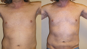 liposuction Before & After Photos