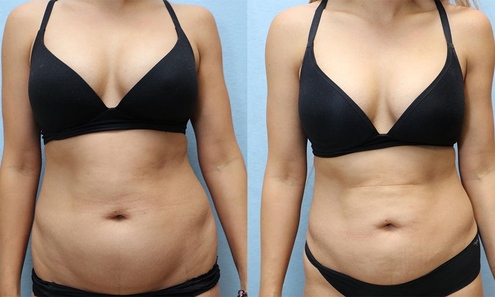 Liposuction Before & After Photos