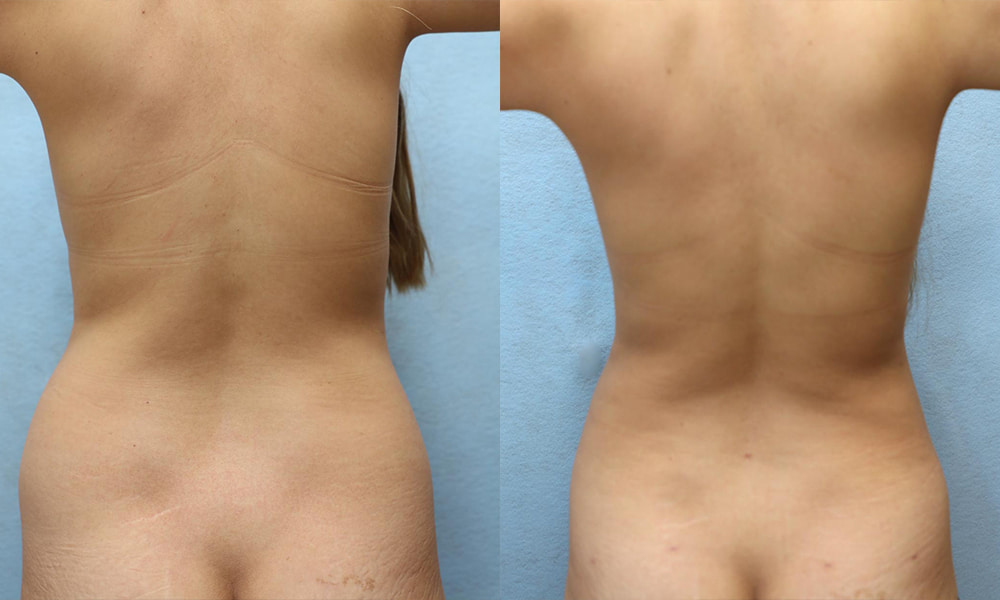 Liposuction Before & After Photos