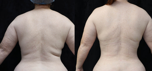 Liposuction Before & After Photos