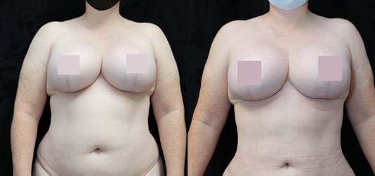 Liposuction Before & After Photos