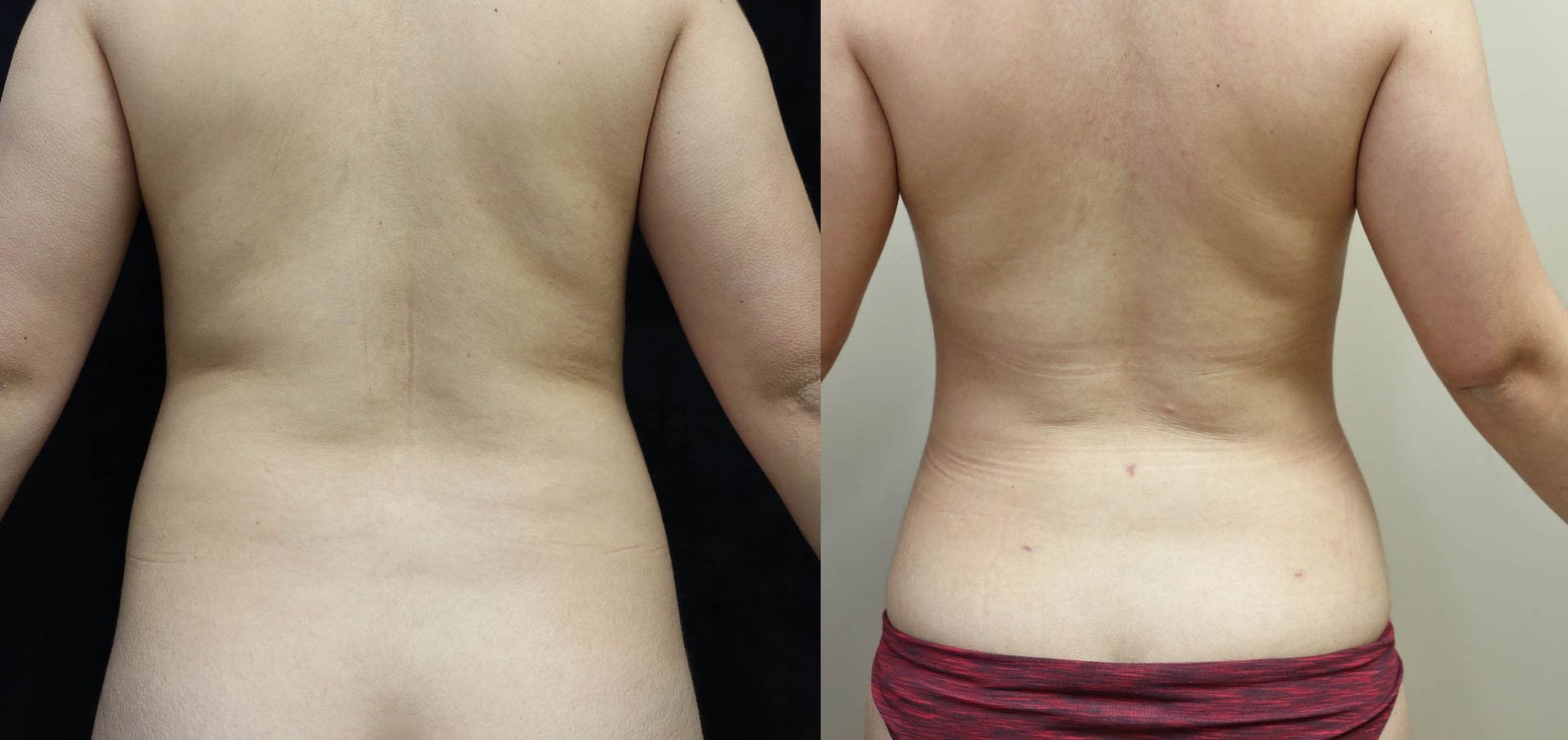 Liposuction Before & After Photos