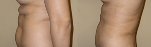 Abdomen, Flanks, and Back liposuction surgery Left