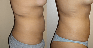 Abdomen, Flanks, and Back liposuction Before & Afte Photos Right surgery