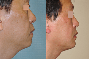 neck liposuction Before & Afte Photos Right
