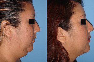 neck Liposuction Before & After Photos Right