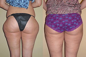 liposuction Before & After Photos Back