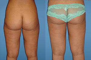 thighs liposuction Before & After Photos