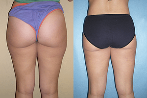 liposuction Before & After Photos Back