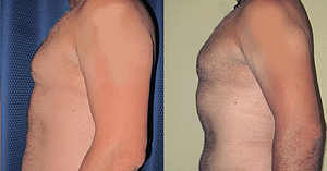 liposuction Before & After Photos