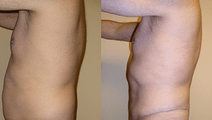 liposuction Before & After Photos