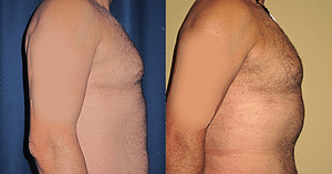 liposuction Before & After Photos