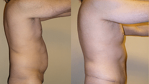 liposuction Before & After Photos