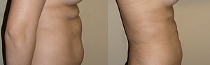 Abdomen, Flanks, and Back liposuction surgery Before & Afte Photos Right