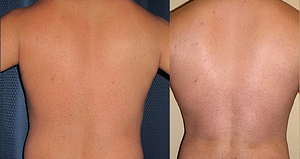 liposuction Before & After Photos