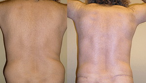 liposuction Before & After Photos