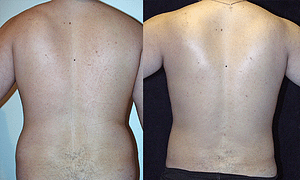 Abdomen, and Chest Liposuction Before & After Photos Back